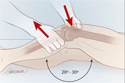 With the patient lying in the supine position, flex the knee 20° to 30° while the heel rests on the end of the exam table. Grasp the femur with the nondominant hand to prevent movement of the upper leg. Then, grasp the lower leg at the proximal tibia and apply a forward tug. This movement should produce a firm endpoint. If the endpoint is not firm or there is increased anterior translation of the tibia, the Lachman test is positive.